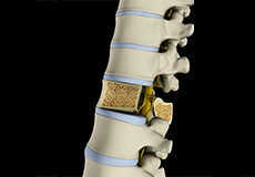 Osteoporosis & Spine