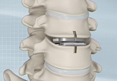 Cervical Disc Prolapse & Surgery