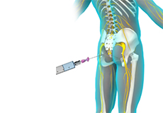 Coccyx Injections & Coccydynia