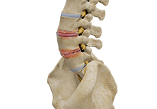 Degenerative Disc, Discogenic pain, Surgical Treatment options (Fusion surgery)