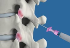 Facet Joint Injections