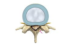 Lumbar Spinal Stenosis & Laminectomy Surgery