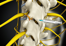 Medial Branch Block of Facet Joints 