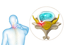 Cervical Stenosis & Myelopathy, Surgical Options