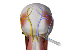 Occipital Nerve Injection