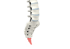 Removal of Coccyx for Coccyx Pain (Coccygectomy)