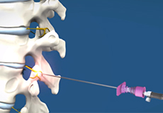 Rhizolysis or Heat Denervation (lesioning) of Facet Joints