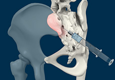 Sacro-iliac Joint Injection