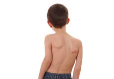 Scoliosis 