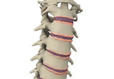 Spondylolysis & Spondylolisthesis, Surgical treatment