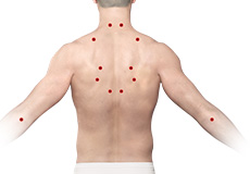 Trigger Point Injections